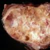 Медуллярный рак щитовидной железы — что это такое?