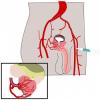 Показания и противопоказания к эмболизации артерий простаты