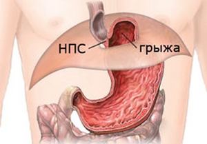 Moving hiatal hernia: how to recognize and treat the disease in time?