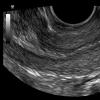 Ecografia transvaginale: tutto sul meraviglioso metodo a ultrasuoni durante la gravidanza metodo transvaginale