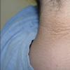 Causes of Acanthosis Black and Treatment Methods Acanthosis Black in Human Symptoms