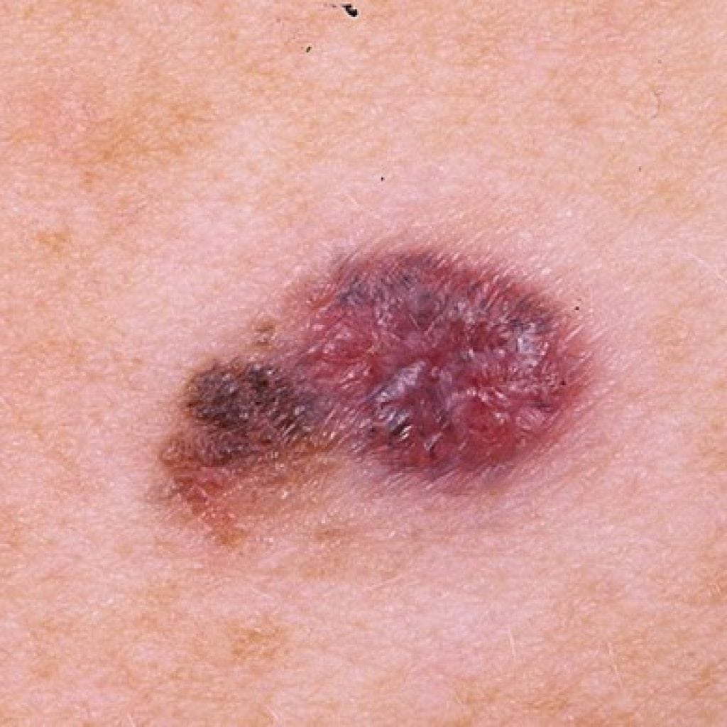 Kas ir melanoma, cēloņi, simptomi un ārstēšana