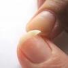 Broken nail: why you dream, interpretation of sleep