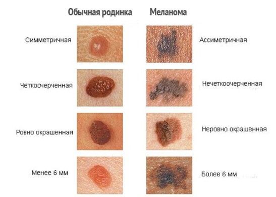 मेलेनोमा (फोटो), उपचार और रोग का लक्षण