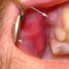 Fistola del dente dopo l'estrazione del dente: cause, sintomi concomitanti, trattamento, prevenzione Fistola del trattamento del dente