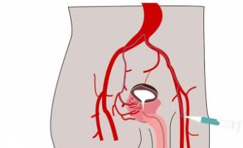 Indicazioni e controindicazioni all'embolizzazione dell'arteria prostatica