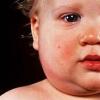 Symptoms and dangerous consequences of mumps in children