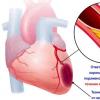 Diabete mellito e malattie cardiovascolari Angina pectoris e diabete mellito