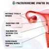 Uterus Endometriosis - What It Is and How to Treat